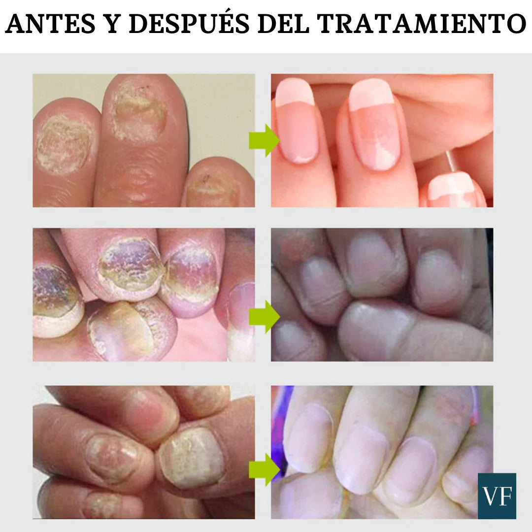Gel de uñas anti hongos y bacterias - Repair Efero®