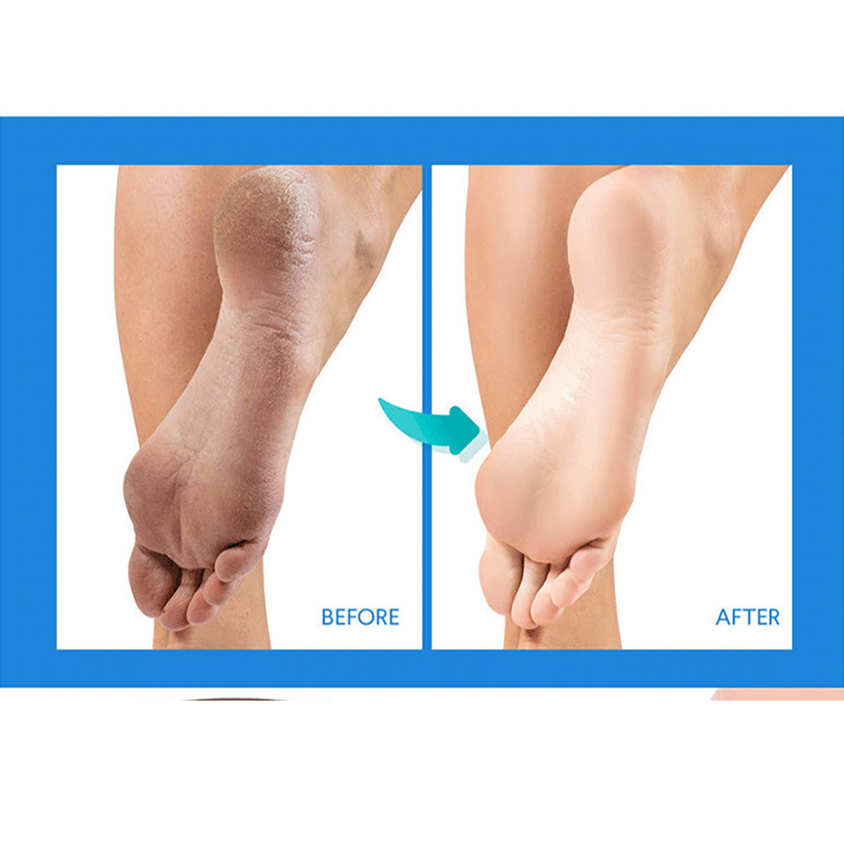 Removedor de Callos 🦶  Electrico Recargable 🔋